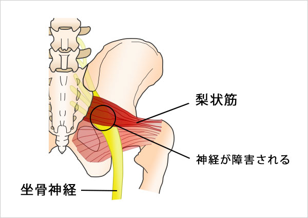 梨状筋症候群(坐骨神経痛)