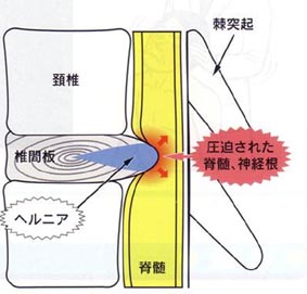 頚椎椎間板ヘルニア