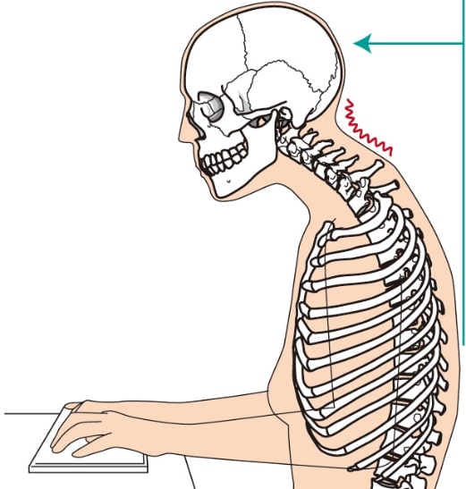 デスクワークによるストレートネック